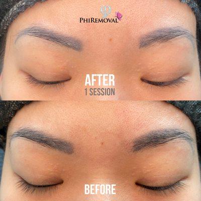 Before and after one session of PhiRemoval to lighten and remove these uneven and poorly shaped powder brows done elsewhere.