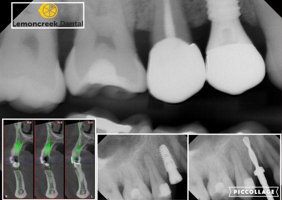 Immediate dental implant placement- 3D treatment planned. Perfect execution.