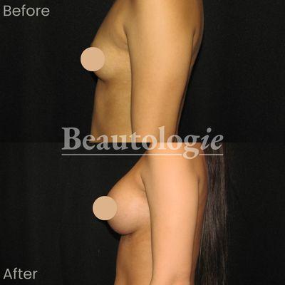 Bilateral Breast Augmentation with 400ml Saline Implants Before and After by Dr. James Knoetgen