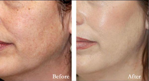 Diamond Microderm Treatments