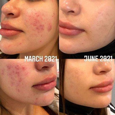 Skin progress with acne treatments at Derma Noor dermatology