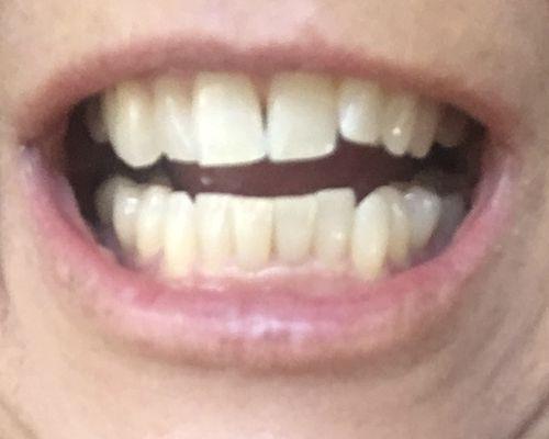 Before and after Envisalign treatment