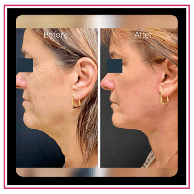 Face/Neck Lift w/CO2 Laser Skin Resurfacing