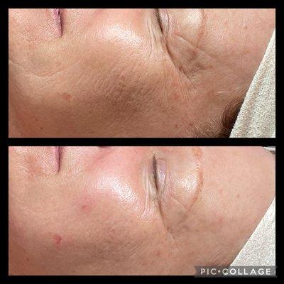 This is the difference immediately after  just 1 jet plasma session. I'm telling you, it's like a magic wand with zero down time.