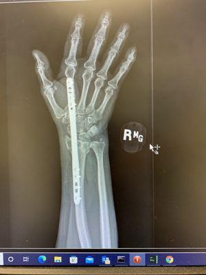 Titanium plate installed through finger and arm used to "Stabilize" my broken wrist