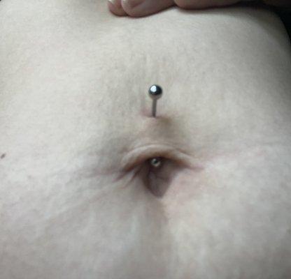 Incorrectly pierced belly piercing