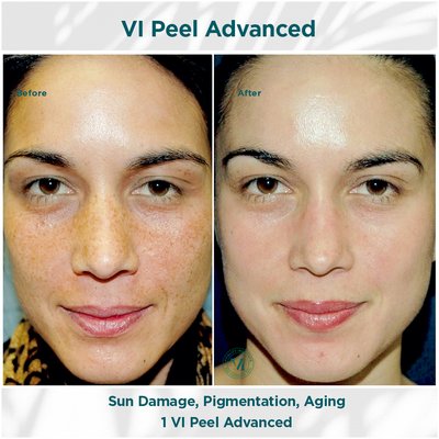 Sun Damage, Pigmentation
Aging