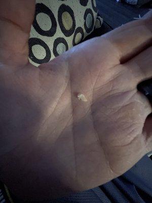 Actual tooth that cracked and fell apart from the terrible filling