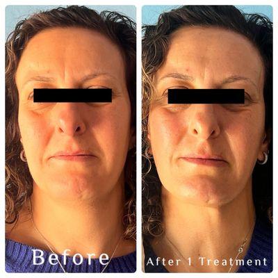 The results after one Botinol Infusion Facial.