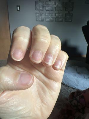 Nails after having acrylic nails taken off today. The white nail is from me almost popping one off while they were on.