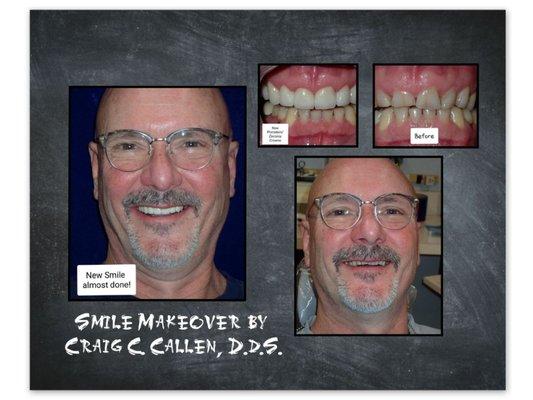 Smile Makeover with Porcelain Crowns