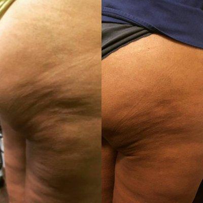 Cavitation and Radiofrequency, 4 sessions. Client 60 years old.