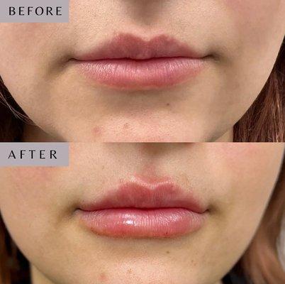 This patient was treated with a half syringe of Juvéderm, giving her subtle volume while maintaining her beautiful lips!