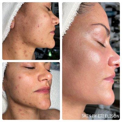 Acne scars before & after