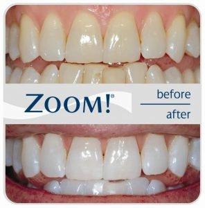 Zoom In- Office 1 Hour Whitening