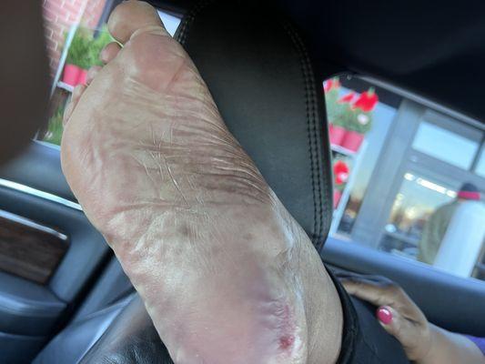 Right foot with skin abrasion.