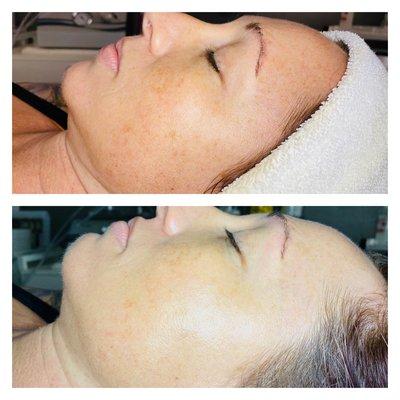 JanMarini luminate resurfacing peel great for treating hyperpigmentation.