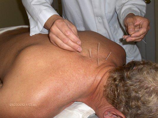 Dr. Quan operates a treatment of acupuncture