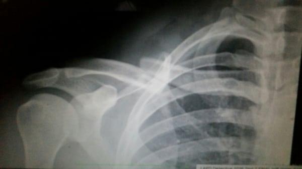 Broken Clavicle!!!