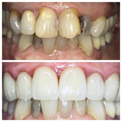 Before and After Zirconium Dental Implants.
  https://www.holisticdentalarts.com/