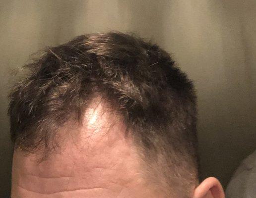 uneven length in front of head that shows  a bolding hair line.