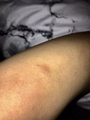 Bruise on my leg