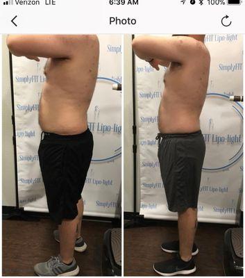 Mid Treatment results. This gentleman had 4 lipo light, 4 b12 lipotropic injections ,was put on healthy strict diet.He lost 16lbs in 2 weeks