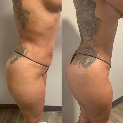 1st Post Lipo massage vs 3rd Post Lipo