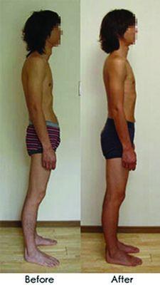 Before and After the Rolfing Ten Session Series .