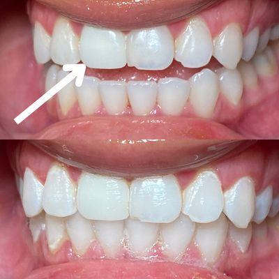 Tooth with the arrow is a crown. This client wanted to see if we can match her teeth with it to match. This was her result and she loved it.