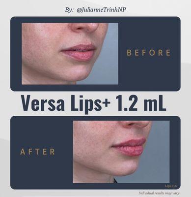 Lip Augmentation by Julianne Trinh NP using Versa Lips+ lip dermal filler lip injections