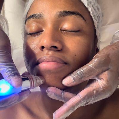 Hydrafacials