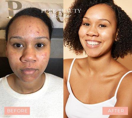 Check out this amazing before and after! Do you suffer from Acne? Sign up for our Acne Bootcamp At www.purebeautybarcincy.com