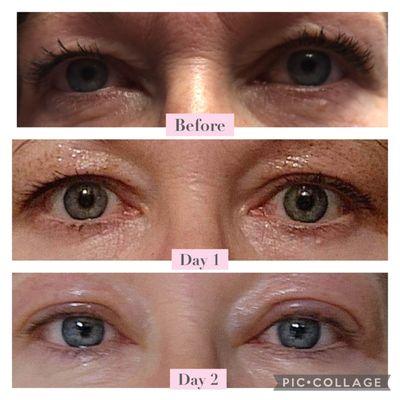 Non-surgical bleph aka eyelift. Used in Europe for decades!  Only $800. 
No needles
No injections
No surgery
Little to no pain