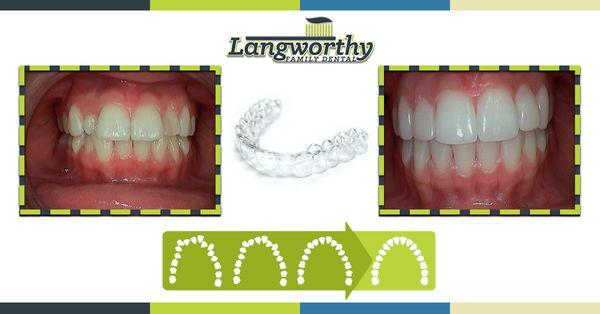 Clear Braces & Teeth Whitening --Real Results!