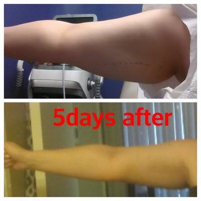 Arm smartlipo...only 5 days after Dr. Bui did smartlipo 500cc removed..no more batwings