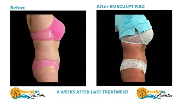 Emsculpt Neo Results