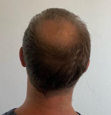 October 2022 - Before hair PRP treatments and the preceding FUE transplant.