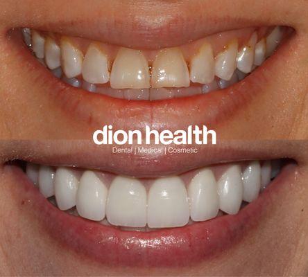 porcelain veneers