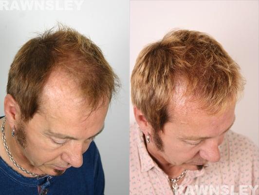 Hair Transplant Before & After | Rawnsley Hair Restoration