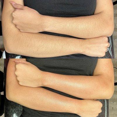 Full arm sugaring before and after.