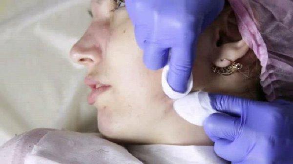 Extractions done on Acne Skin