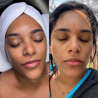 Deep pore cleansing + Peels + homecare lira products