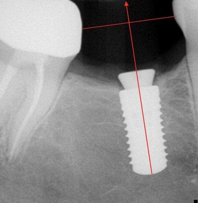 Perfectly positioned implant to replace a missing molar tooth