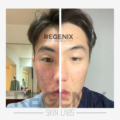 Acne Treatment
Before & After: 3 sessions
Acne Away Package