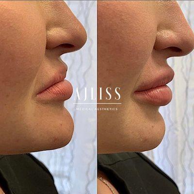 What a transformation a little lip filler makes for the side profile!