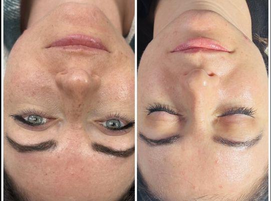 Microneedling with our combo method.