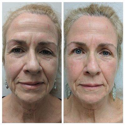 Non Surgical Facelift facial