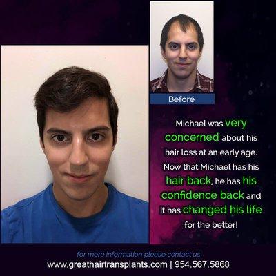 check more @ https://www.greathairtransplants.com/patient/p409/michael/