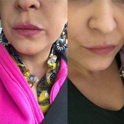 before(right) and after(left) lips fillers